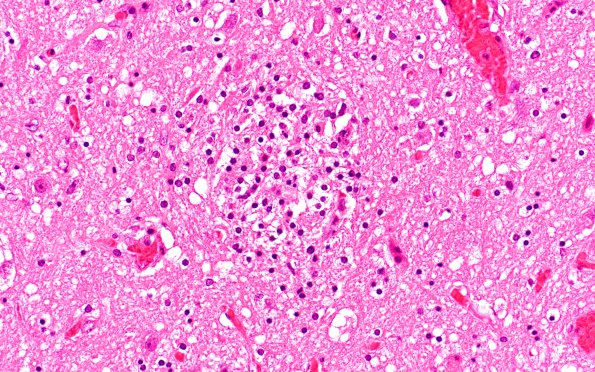 1B2 Encephalitis, neonatal HIV, CMV, 15 mo (Case 1) N9 medulla H&E 11