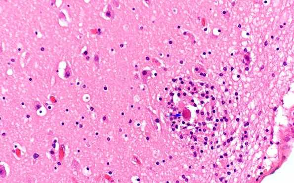 1B3 Encephalitis, neonatal HIV, CMV, 15 mo (Case 1) N3 H&E 3 copy