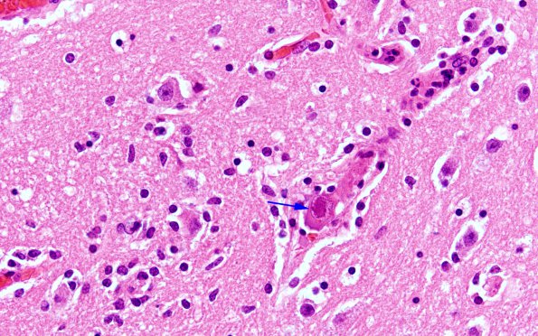 1B4 Encephalitis, neonatal HIV, CMV, 15 mo (Case 1) N3 H&E 1 copy