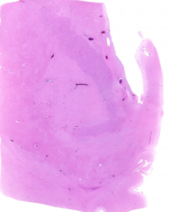 1B5 Encephalitis, neonatal HIV, CMV, 15 mo (Case 1) N2 whole mount A