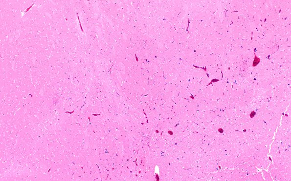 1B6 Encephalitis, neonatal HIV, CMV, 15 mo (Case 1) N2 5