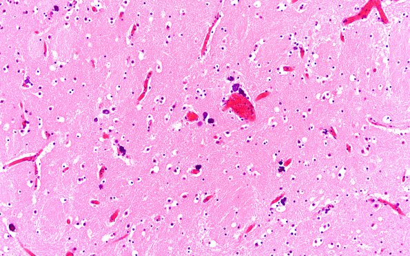 1B7 Encephalitis, neonatal HIV, CMV, 15 mo (Case 1) N2 4