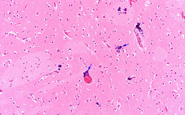 1B8 Encephalitis, neonatal HIV, CMV, 15 mo (Case 1) N2 1 copy