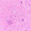 1B9 Encephalitis, neonatal HIV, CMV, 15 mo (Case 1) N2 6 copy