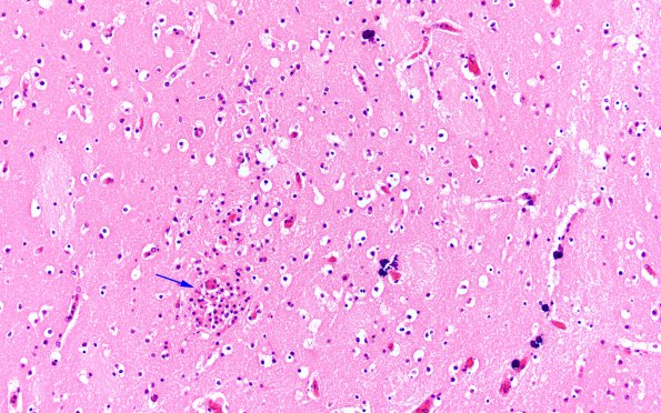 1B9 Encephalitis, neonatal HIV, CMV, 15 mo (Case 1) N2 6 copy