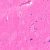 2A2 Encephalitis, neonatal HIV, CMV (Case 2) N2 H&E 5