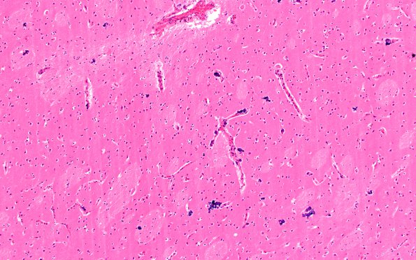 2A2 Encephalitis, neonatal HIV, CMV (Case 2) N2 H&E 5