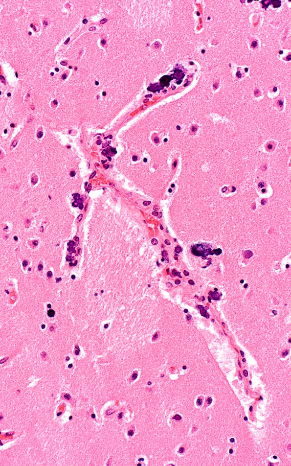 2A3 Encephalitis, neonatal HIV, CMV (Case 2) N2 H&E 4