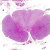 1A1 HIV, vacuolar myelopathy (Case 1) H&E 1 whole mount