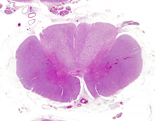 1A1 HIV, vacuolar myelopathy (Case 1) H&E 1 whole mount