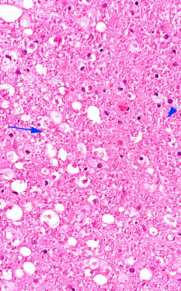 1A10 HIV, vacuolar myelopathy (Case 1) 3 H&E 40X copy