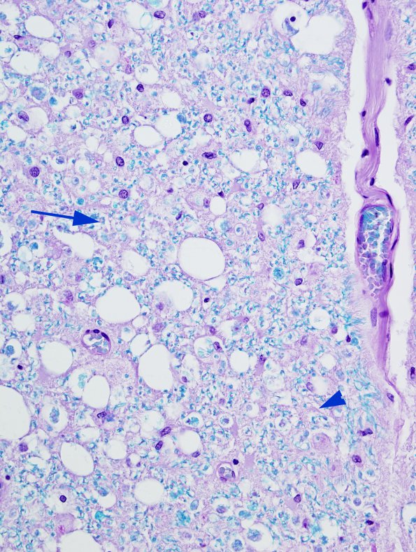 1A11 HIV, vacuolar myelopathy (Case 1) 3 LFB-PAS 40X copy