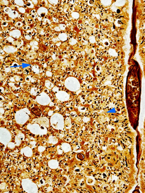 1A12 HIV, vacuolar myelopathy (Case 1) 3 Biels 40X copy