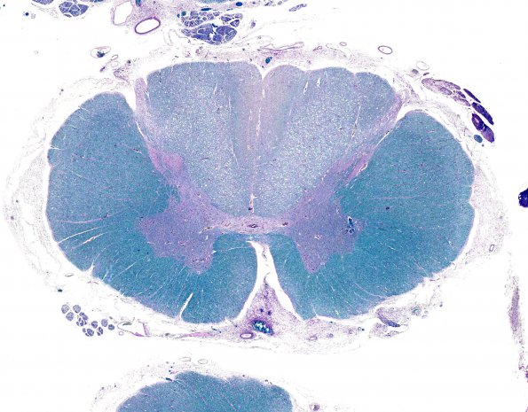 1A2 HIV, vacuolar myelopathy (Case 1) LFB-PAS 1 whole mount