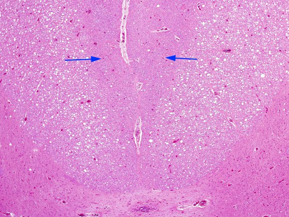 1A4 HIV, vacuolar myelopathy (Case 1) H&E 4X copy