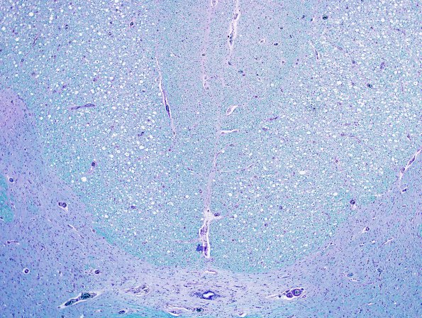 1A5 HIV, vacuolar myelopathy (Case 1) LFB-PAS 4X A