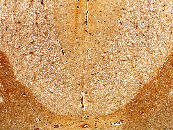 1A6 HIV, vacuolar myelopathy (Case 1) Biels 4X c