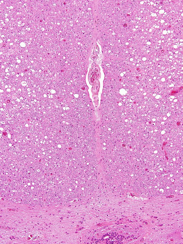 1A7 HIV, vacuolar myelopathy (Case 1) H&E 10X