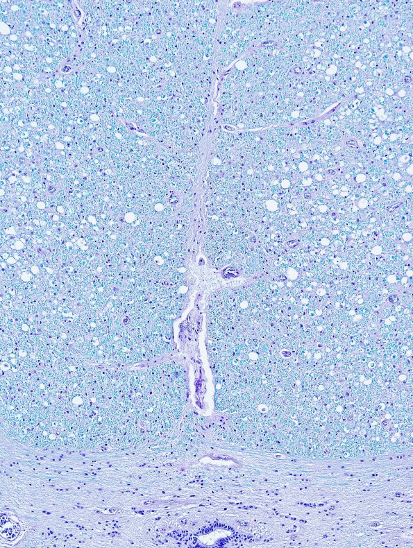 1A8 HIV, vacuolar myelopathy (Case 1) LFB-PAS 10X