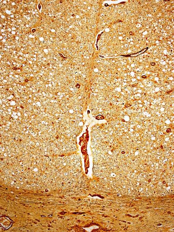 1A9 HIV, vacuolar myelopathy (Case 1) Biels 10X