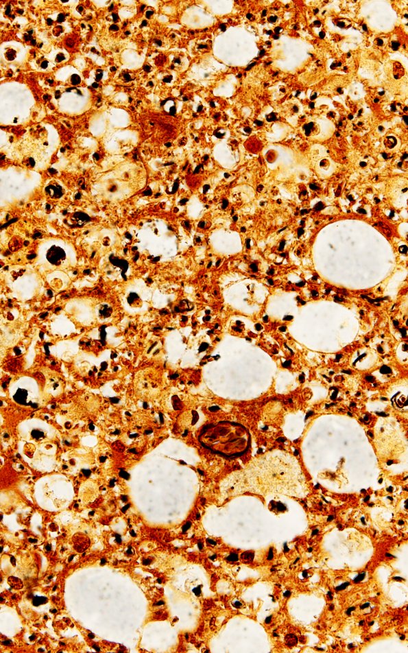 1B2 HIV, vacuolar myelopathy (Case 1) 3 Biels 60X