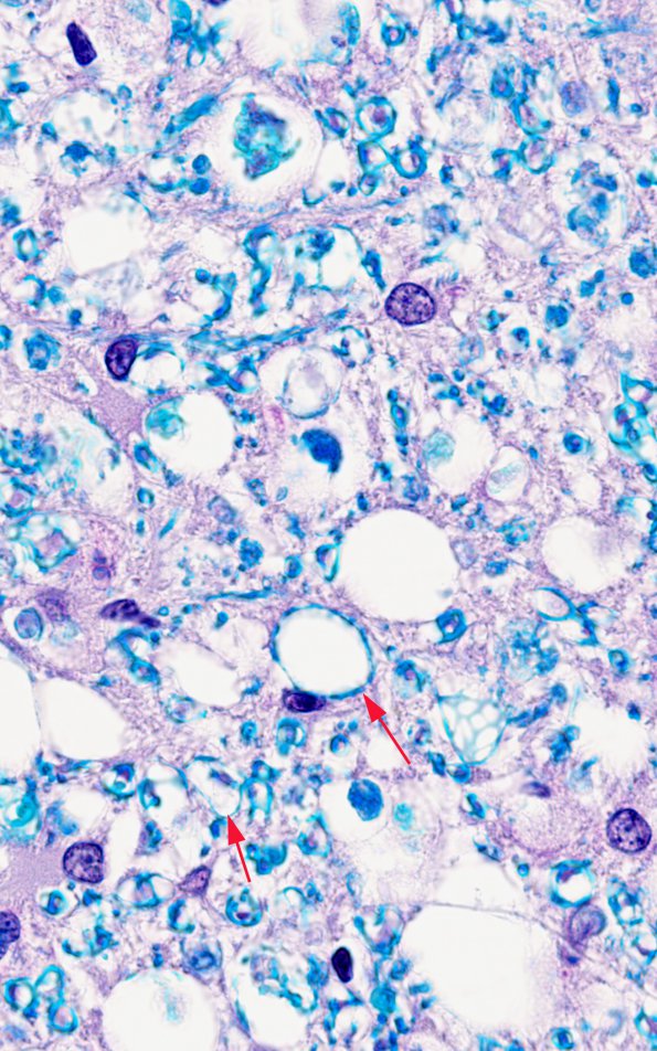 1B3 HIV, vacuolar myelopathy (Case 1) 3 LFB-PAS 100X 1 copy