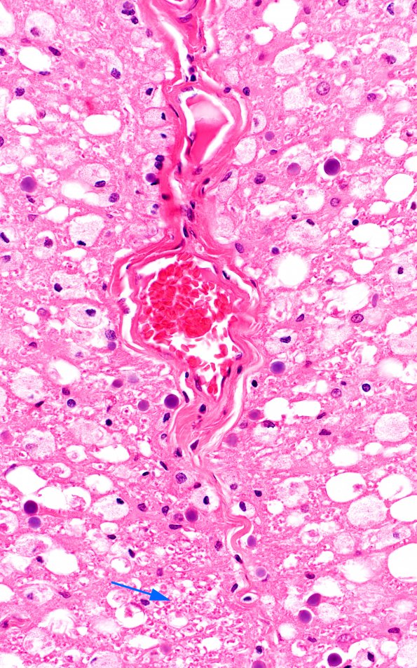 2A1 HIV, vacuolar myelopathy (Case 2) 2 LFB-PAS 40X copy