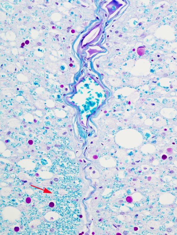 2A2 HIV, vacuolar myelopathy (Case 2) 2 LFB-PAS 40X copy