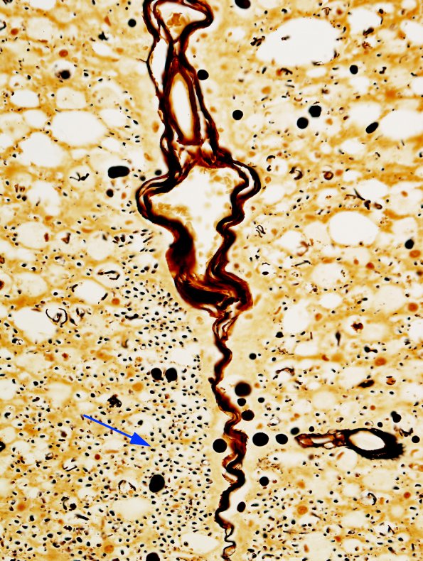 2A3 HIV, vacuolar myelopathy (Case 2) 2 Bielschowsky 40X copy