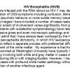 0A HIV Encephalitis - Text