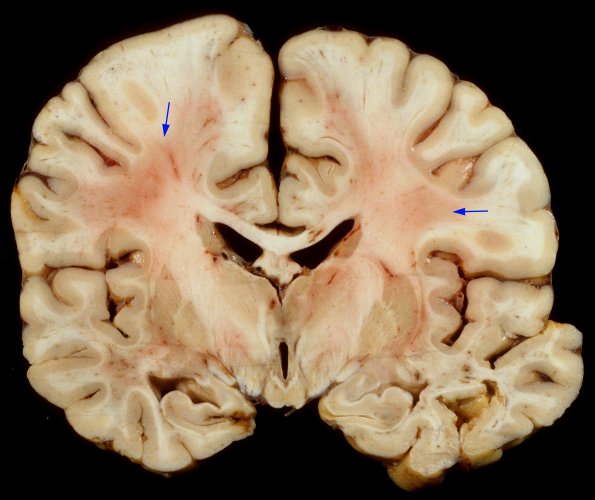 1A1 HIVE & HIVL, fulminant (Case 1) 1 copy