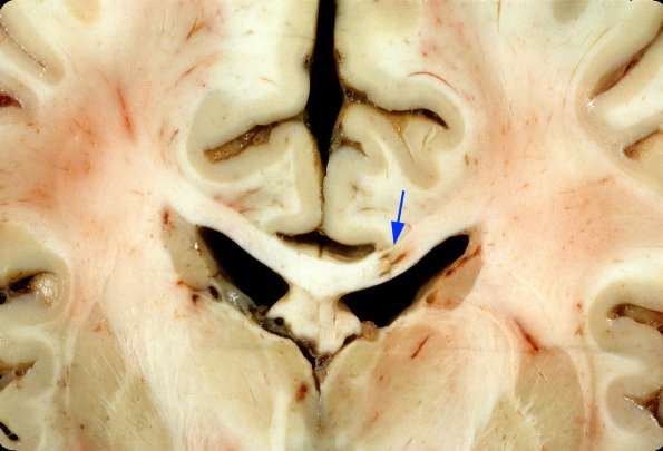 1A2 HIVE & HIVL, fulminant (Case 1) 2 copy