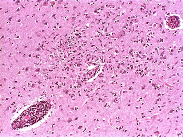 1B1 HIVE & HIVL, fulminant (Case 1) H&E 1