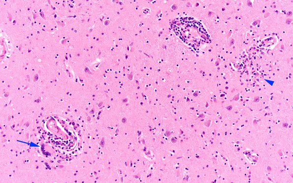 1B2 HIVE & HIVL, fulminant (Case 1) N4 H&E 3 copy