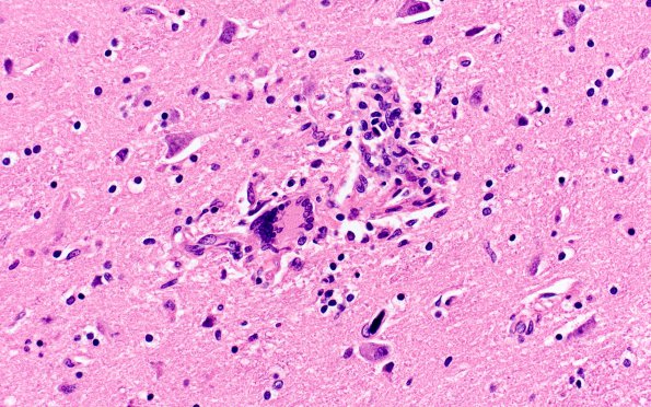 1B3 HIVE & HIVL, fulminant (Case 1) N4 H&E 4