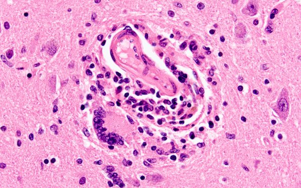 1B4 HIVE & HIVL, fulminant (Case 1) N4 H&E 2