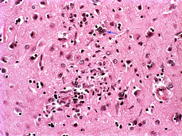 1B5 HIVE & HIVL, fulminant (Case 1) H&E 5 copy