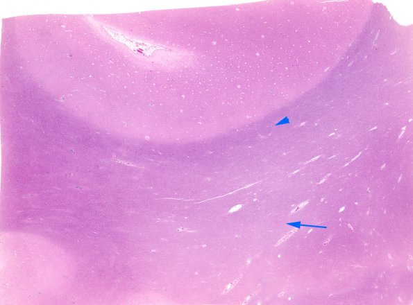 1C1 HIVE & HIVL, fulminant (Case 1) H&E whole mount copy