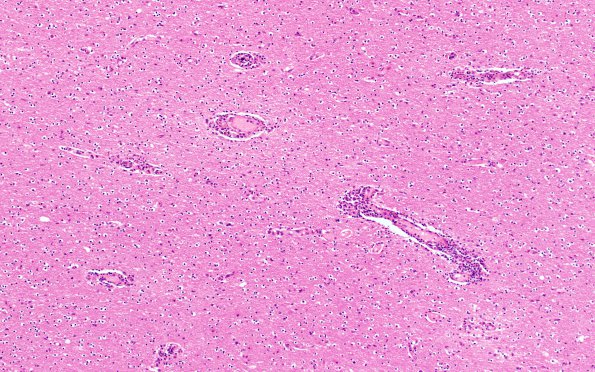 1C3 HIVE & HIVL, fulminant (Case 1) N1 H&E 5