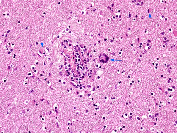 1C4 HIVE & HIVL, fulminant (Case 1) H&E (2) copy