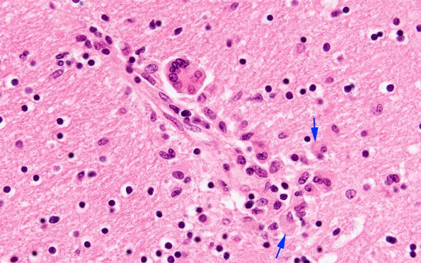 1C5 HIVE & HIVL, fulminant (Case 1) N1A H&E 3 copy