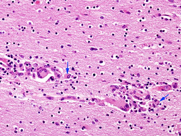 1C6 HIVE & HIVL, fulminant (Case 1) H&E 40X 2 copy