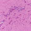 1D3 HIVE & HIVL, fulminant (Case 1) substantia nigra N6 H&E 2