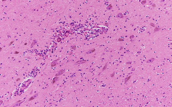 1D3 HIVE & HIVL, fulminant (Case 1) substantia nigra N6 H&E 2