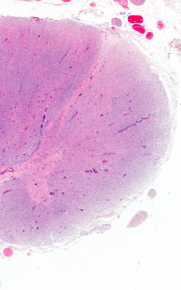 1E2 HIVE & HIVL, fulminant (Case 1) spinal cord N10A H&E 1A