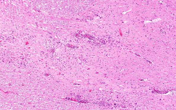 1E3 HIVE & HIVL, fulminant (Case 1) spinal cord N10A N10 H&E 1A