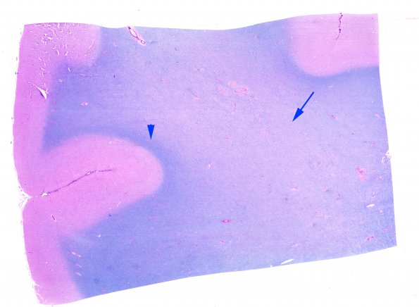 2A1 HIV Leukoencephalitis (Case 2) LFB-PAS whole mount copy A