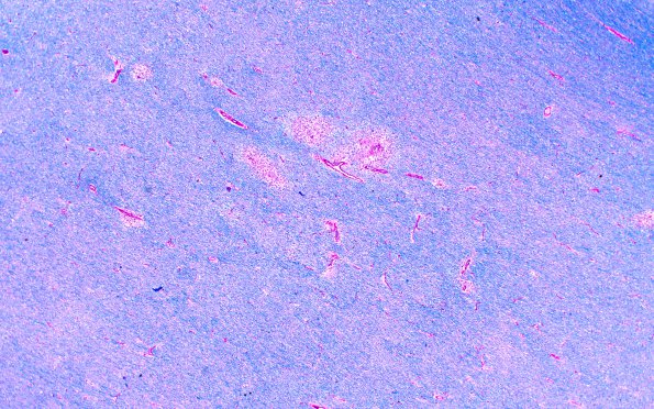 2A2 HIV Leukoencephalitis (Case 2) LFB-PAS 1