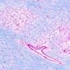 2A3 HIV Leukoencephalitis (Case 2) LFB-PAS 5