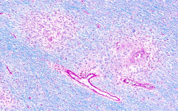 2A3 HIV Leukoencephalitis (Case 2) LFB-PAS 5